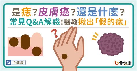 腹部長痣|是痣？皮膚癌？還是什麼？常見Q&A解惑！醫教揪出「。